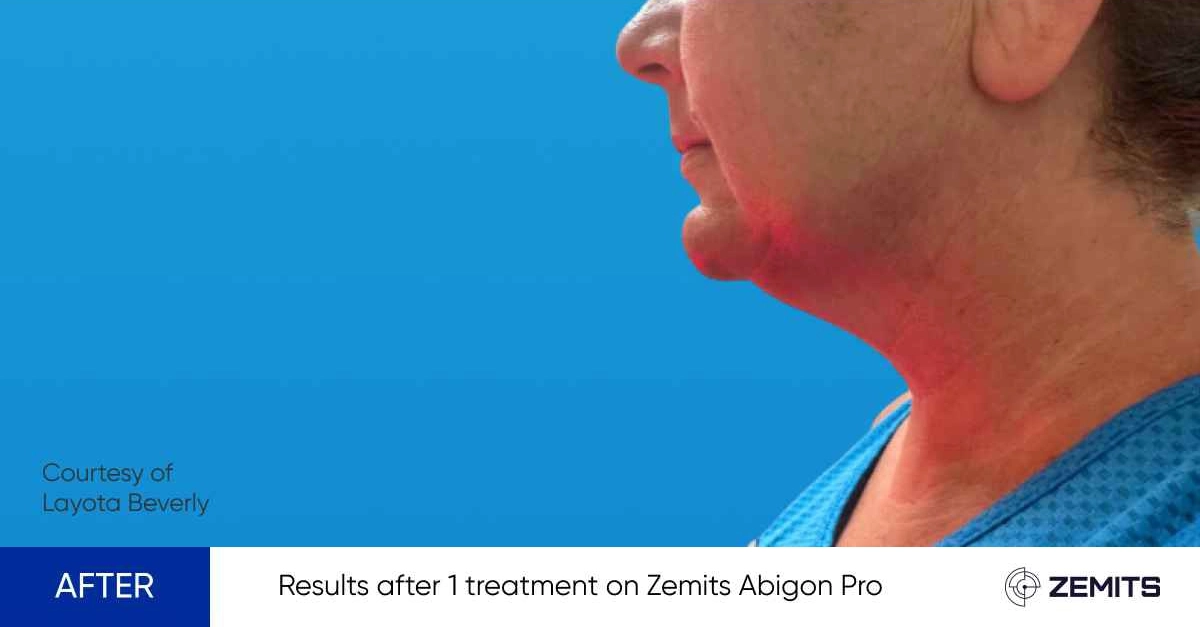 Results after 1 treatment on Zemits Abigon Pro chin