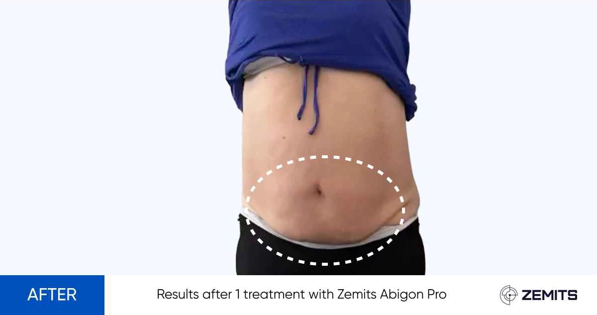 Results after 1 treatment with Zemits Abigon Pro before on stomach after