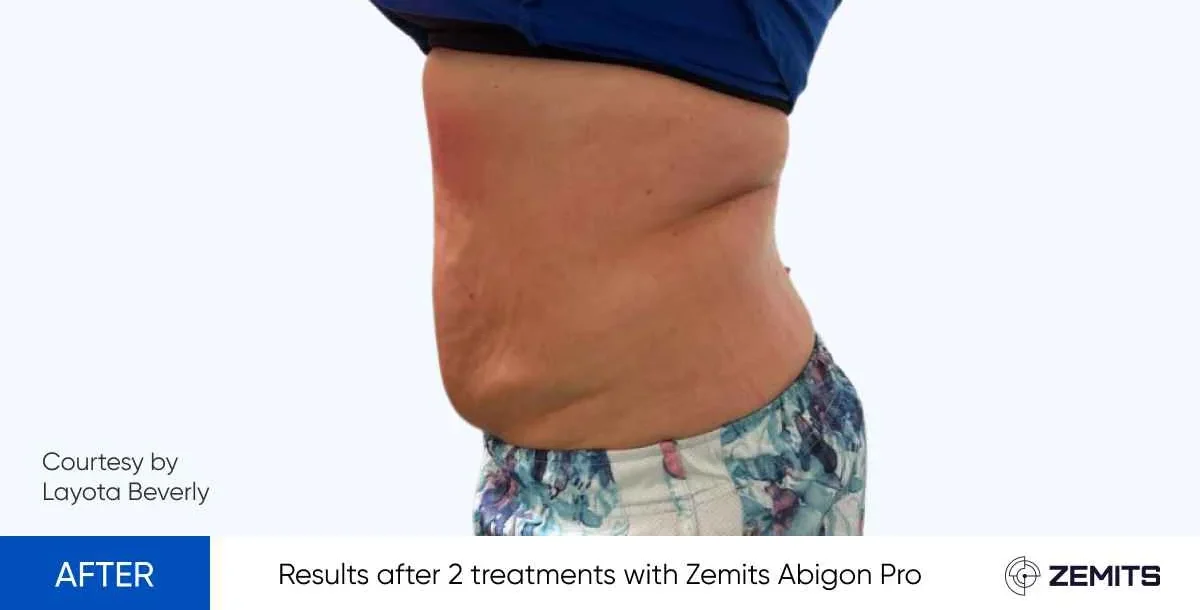 Results after 2 treatments with Zemits Abigon Pro - after