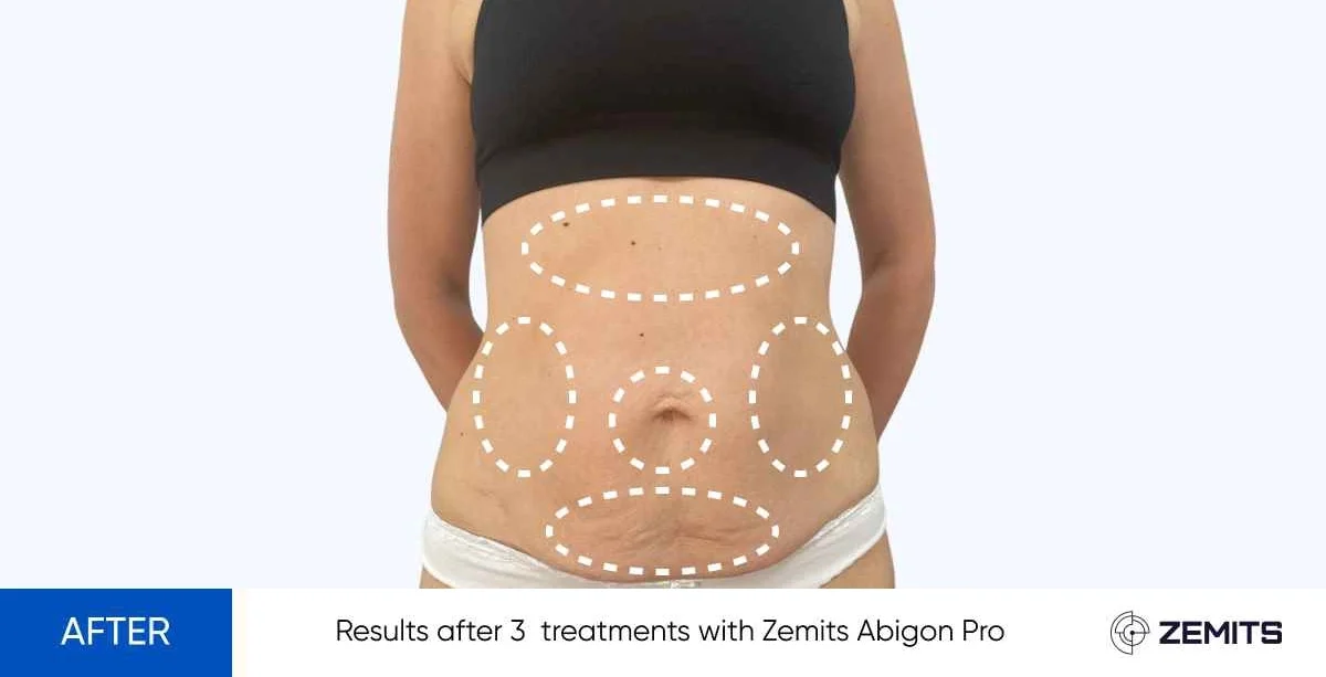 Results after 3 treatments with Zemits Abigon Pro after