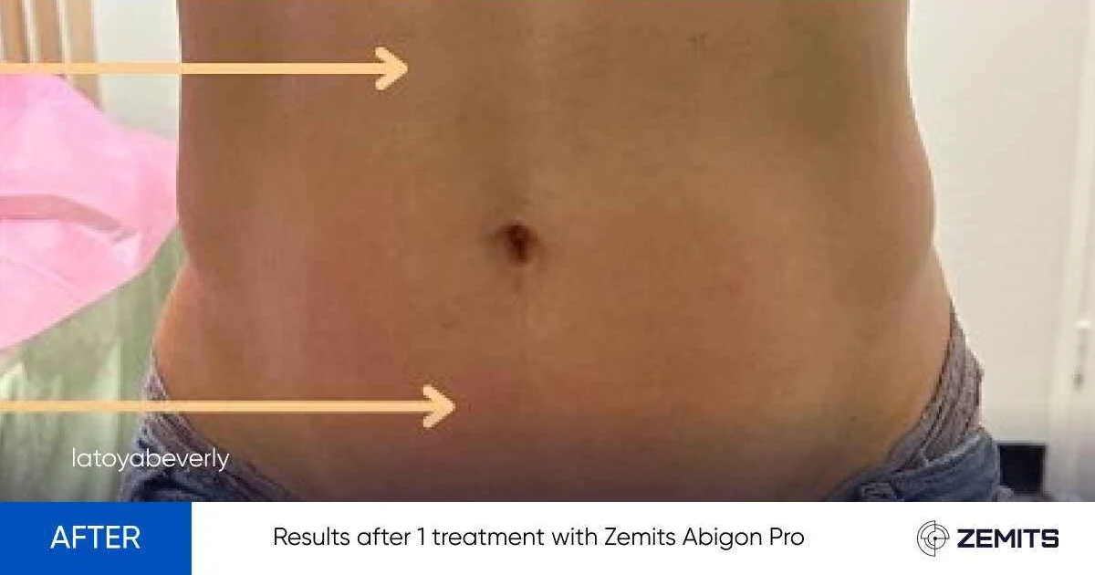 results-after-1-treatment-with-zemits-abigon-pro-1 after